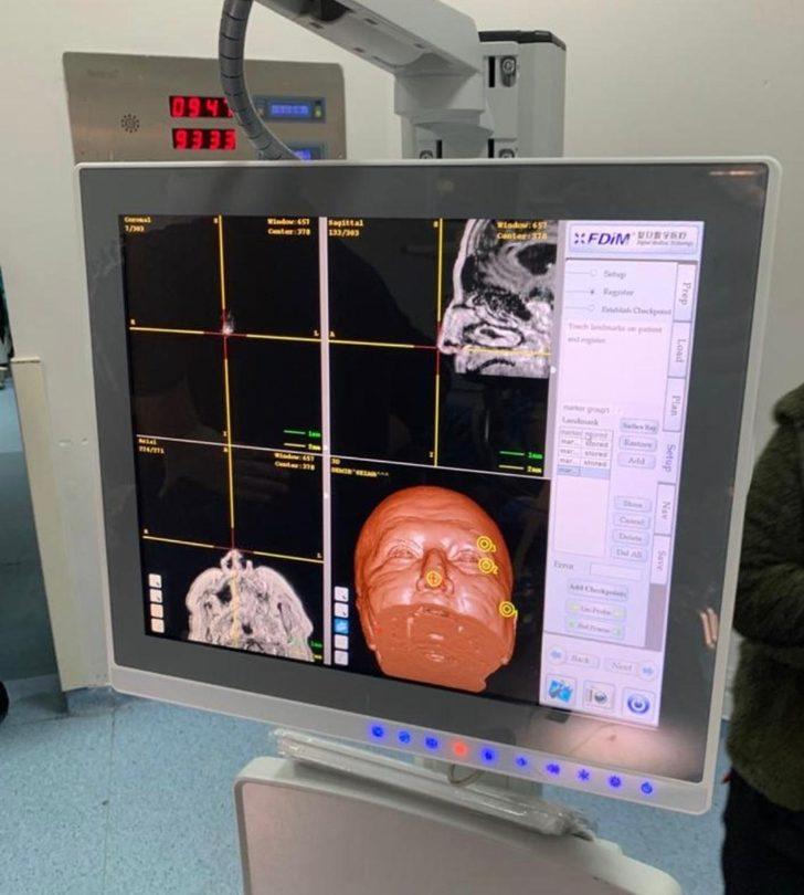 BAÜN Hastanesi’nde riskli beyin ameliyatı başarıyla yapıldı G5