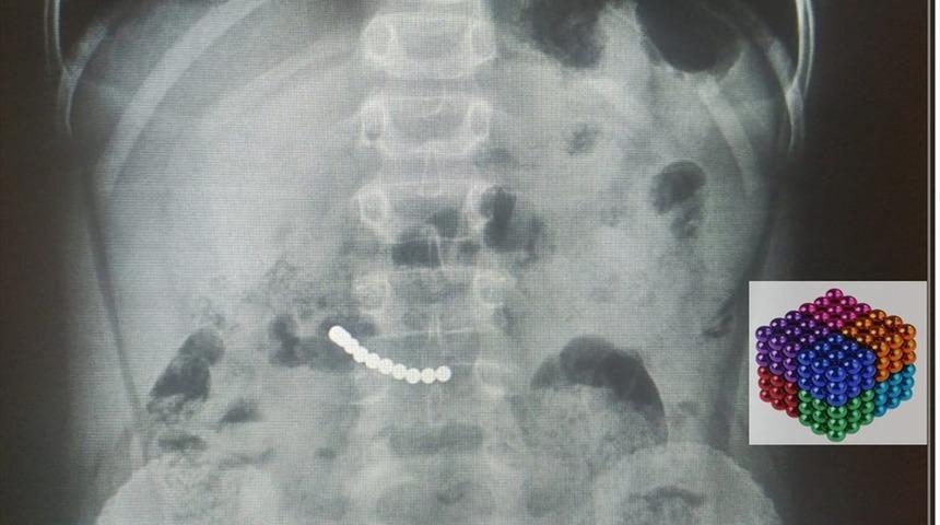 7 yaşındaki çocuğun midesinden 11 mıknatıs çıktı