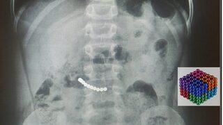 7 yaşındaki çocuğun midesinden 11 mıknatıs çıktı