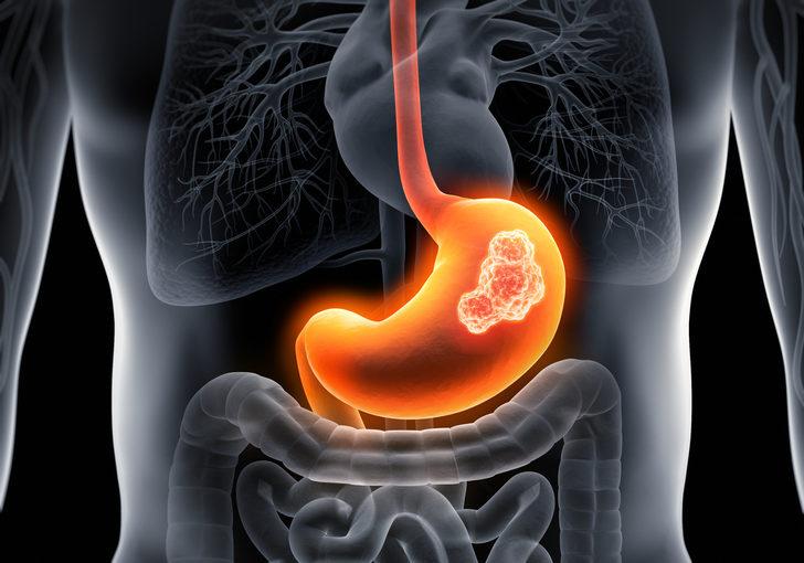Mide kanseri nedenleri arasında gastrit de var! Mide kanserinden Mide kanseri nedenleri arasında gastrit de var! Mide kanserinden