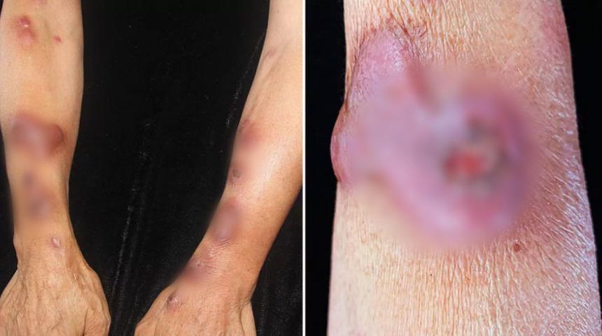 Balık ayıklarken enfeksiyon kaptı! Elini kolunu kullanamaz hale geldi