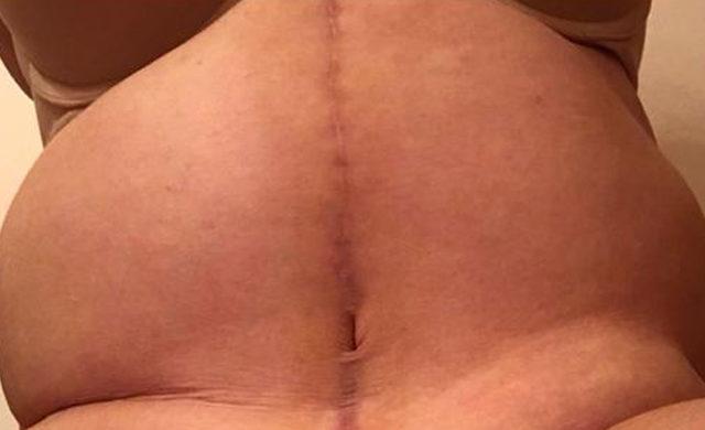 CATERS_FIVE_BOTCHED_TUMMY_TUCKS_011_3427634