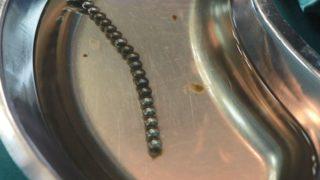 Küçük çocuğun bağırsağından tam 19 tane mıknatıs çıktı! Herkesi şaşkına çevirdi