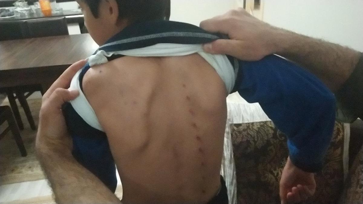 10 yaşındaki &ccedil;ocuğu tırmıkla yaraladı