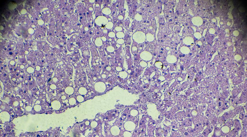 Karaciğer yağlanması nedenleri arasında mutasyonlu gen de var! Artık zayıfları da etkiliyor
