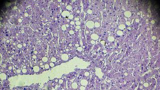 Karaciğer yağlanması nedenleri arasında mutasyonlu gen de var! Artık zayıfları da etkiliyor