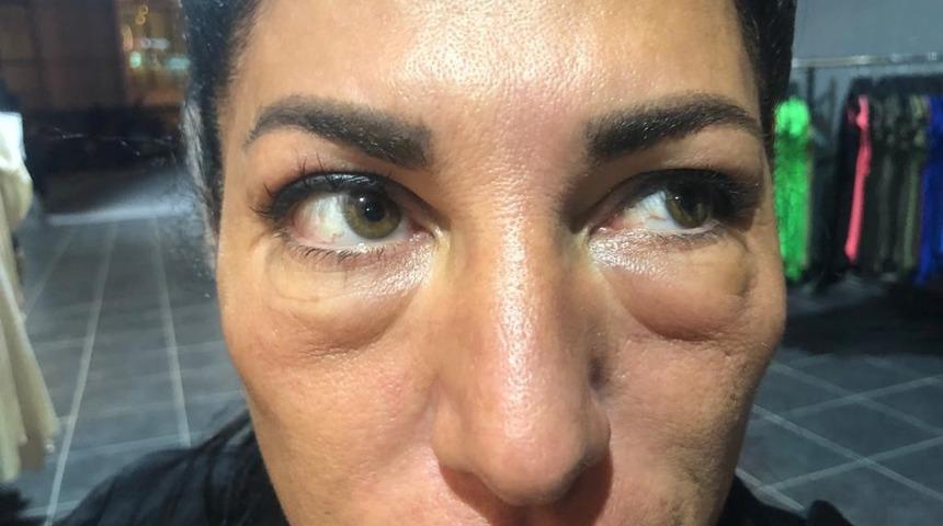 G&ouml;zaltı ışık dolgusu hayatını kararttı! G&ouml;ren tanıyamıyor