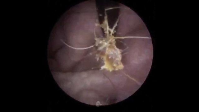CATERS_EAR_WAX_REMOVAL_05_3428390