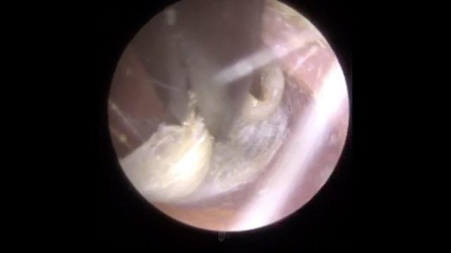CATERS_EAR_WAX_REMOVAL_07_3428392