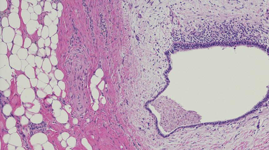 Endometriozis nedir, belirtileri ve tedavisi nasıl olur? Türkiye'nin ilk endometriozis hastası anlattı