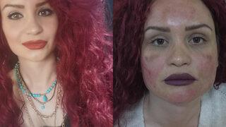 Leke tedavisi için gittiği güzellik merkezinde yüzünde yanık oluştuğunu iddia etti