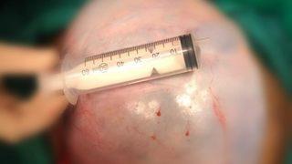 'Kilo aldım sanıyordum!' Karın ağrısı şikayetiyle gitti, yumurtalığından 20 kilo kitle çıkarıldı