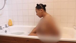 Banyo yapmak da kabus, ağlamak da! Suya alerjisi olan kadın her gün acı içinde kıvranıyor