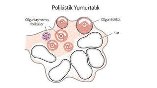 Polikistik over sendromu nedir? İşte polikistik over sendromunun belirtileri