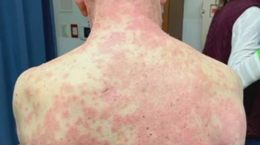 Korona aşısı bu hale getirdi! Tüm vücudu kıpkırmızı oldu, tanınmayacak hale geldi
