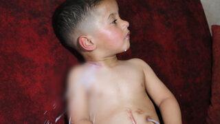 3 yaşındaki çocuğun doğuştan yemek borusu yok: İçtiği sıvı gıdalar boğazındaki delikten geri dökülüyor