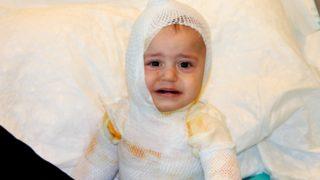 Üzerine kaynar süt dökülen 1 yaşındaki çocuk feci şekilde yandı