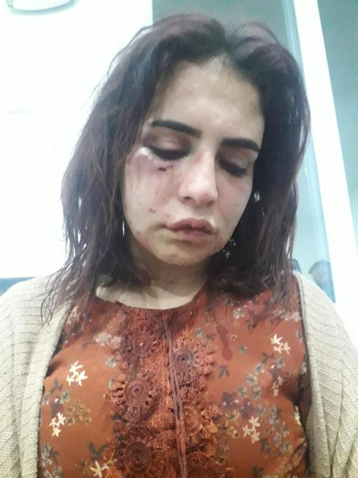 Eski sevgilisi tarafından darp edilen gen&ccedil; kızın &ldquo;&Ouml;lmek istemiyorum&rdquo; paylaşımı