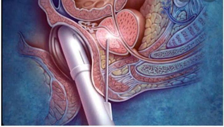 Çarşamba Devlet Hastanesi’nden ‘prostat’a erken müdahale G2