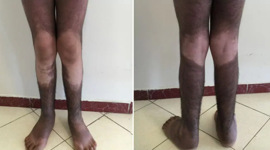 130 kişide var, tedavisi yok! Ten rengi birden değişmeye başladı