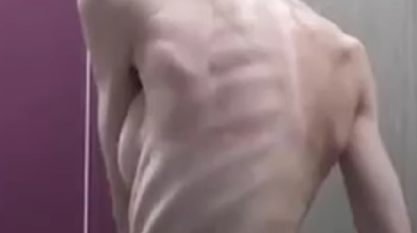 Anokreksiya ile mücadele eden Lara Rebecca’nın hayatı sosyal medyada gündem oldu