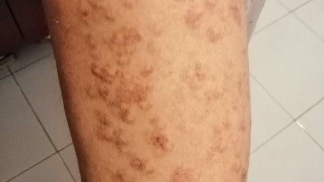 Lazer epilasyonda bacaklarında 'yanık oluştuğu' iddiasıyla şikayetçi oldu