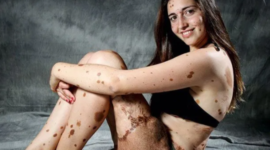 Vücudundaki lekeler ve izler nedeniyle hayatı boyunca dalga geçilen Alba Parajo’nun ilham veren hikayesi