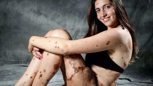 Vücudundaki lekeler ve izler nedeniyle hayatı boyunca dalga geçilen Alba Parajo’nun ilham veren hikayesi