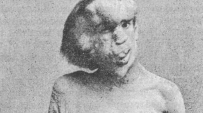 Hastalığından dolayı toplum tarafından dışlandı! Ölümünden yüz yıl sonra teşhis konulabildi