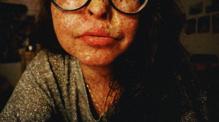 Çocukluğundan beri 28 kez cilt kanseriyle savaştı! ''Normal insan gibi yaşamak çok isterdim'' 