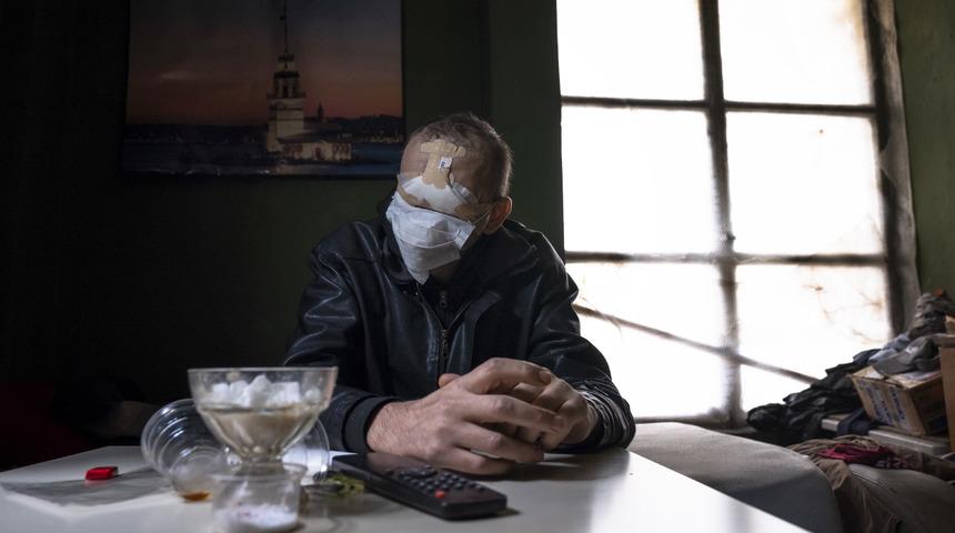 Cilt kanserinden yüzünü kaybeden baba: Kızımı öpmeyi çok özledim