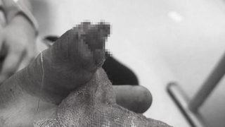 Kopan parmağını sırt çantasında Türkiye'ye taşıdı! 11 saatlik ameliyat literatüre girdi