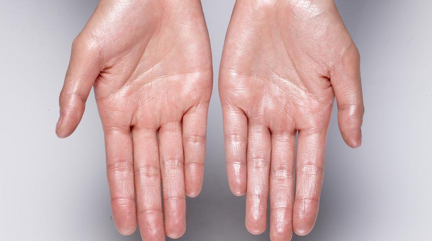 Eldeki terleme hastalık belirtisi mi? Aşırı terleme tedavisi var mı?