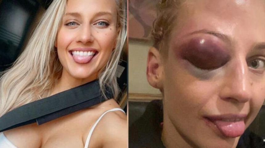 Avustralyalı boksör Ebanie Bridges tanınmaz hale geldi