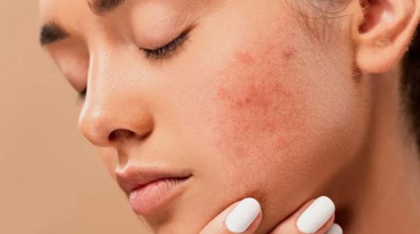 Sivilce deyip geçmeyin