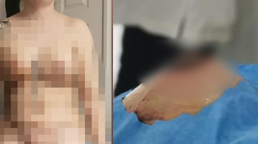 Annelik estetiği kabusu oldu! Hem g&ouml;ğs&uuml;n&uuml; kaybetti hem de 10 bin sterlin harcadı