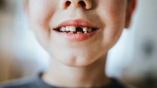 Çocuklarda dişlere acil müdahale edilmeli