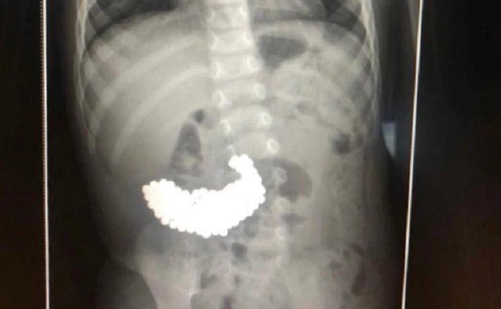 İki yaşındaki çocuğun midesinden 209 mıknatıs topu çıkarıldı G3