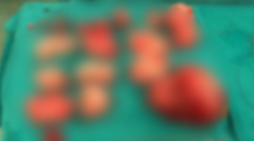 Gerçeği öğrendiğinde şaşkına döndü! Şişkinlik sandı karnından 1,5 kilo miyom çıktı