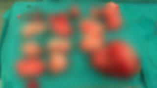 Gerçeği öğrendiğinde şaşkına döndü! Şişkinlik sandı karnından 1,5 kilo miyom çıktı