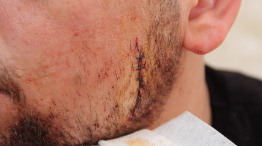 Dehşet saçtı! Kız arkadaşını dövüp, ayırmak isteyen komşunun yüzünü çatalla yaraladı