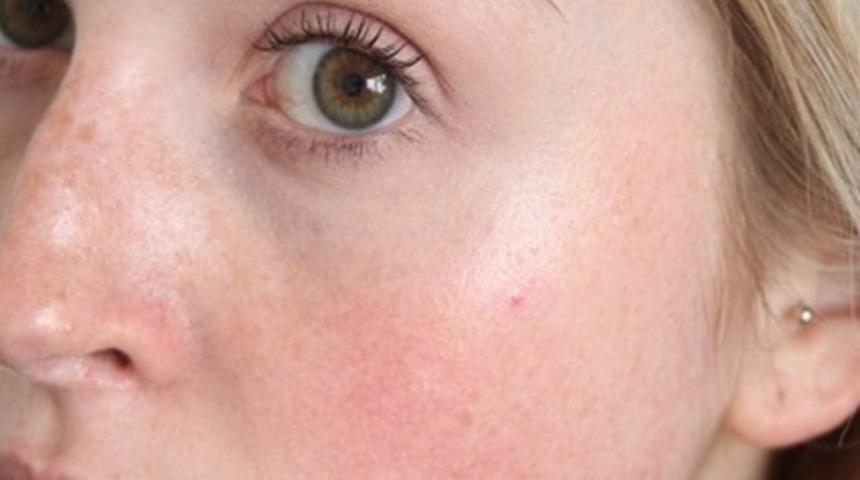 Y&uuml;z terlemesi ve y&uuml;z kızarması