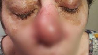 Firavun faresi cehennemi yaşattı! Komadan çıktığında organlarını kaybetti, doktorlar ''yaşamaz'' dedi