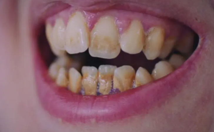 Dişleri nedeniyle gülmeyi unutan kadın şaşkına çevirdi: Dişlerimi gören doktorlar şoka girdi