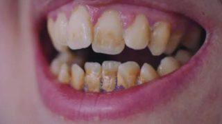 Dişleri nedeniyle gülmeyi unutan kadın şaşkına çevirdi: Dişlerimi gören doktorlar şoka girdi