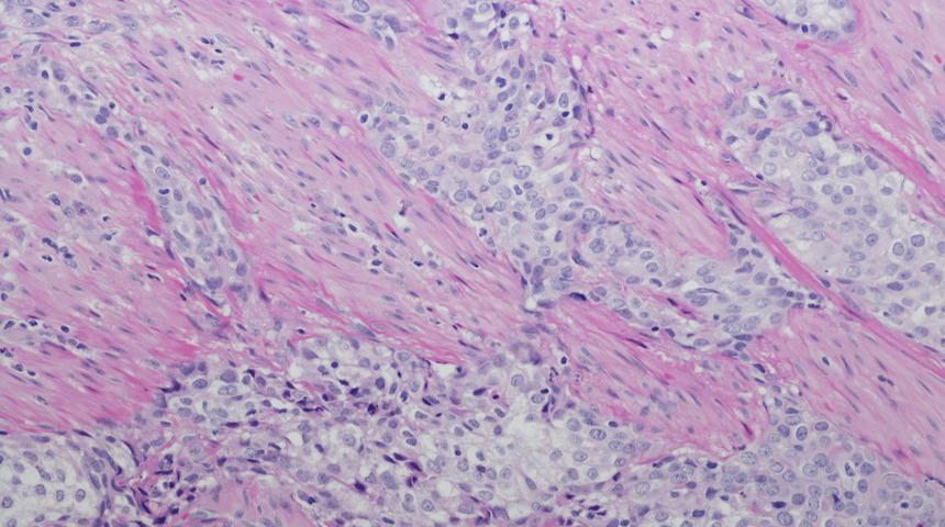 Mesane kanserinde en büyük neden sigara! 