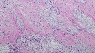 Mesane kanserinde en büyük neden sigara! 