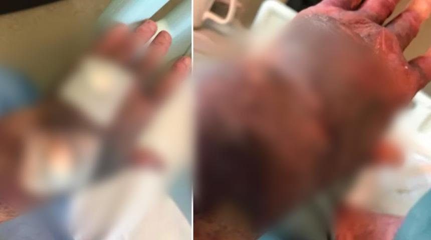 Yaşlı kadının çaresizliği! Koronavirüs aşısı olduktan sonra vücudu morarmaya başladı