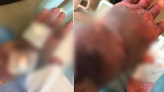 Yaşlı kadının çaresizliği! Koronavirüs aşısı olduktan sonra vücudu morarmaya başladı