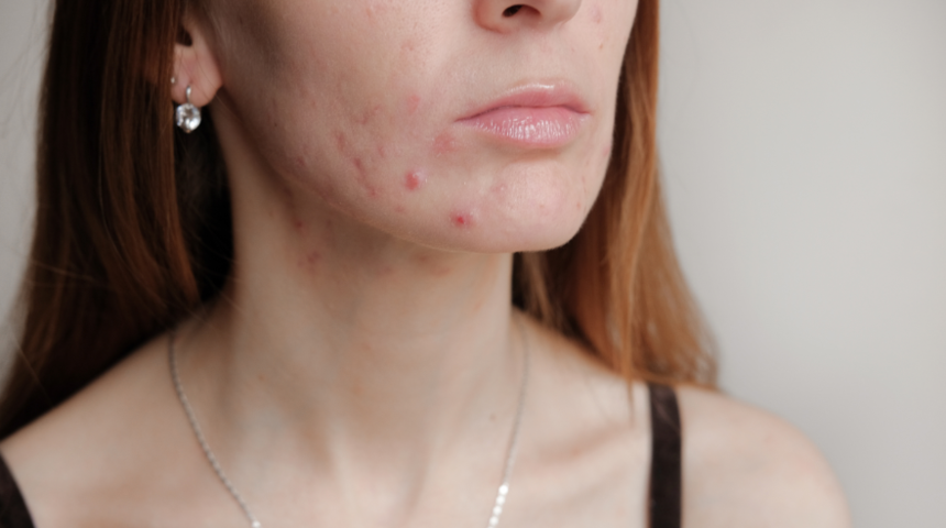 Sivilcelerden kurtulmak için bitkilerden destek alabilirsiniz! Bu yöntemle geçmeyen sivilcelerden anında kurtulabilirsiniz